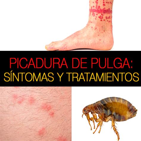 piquetes de pulgas en humanos